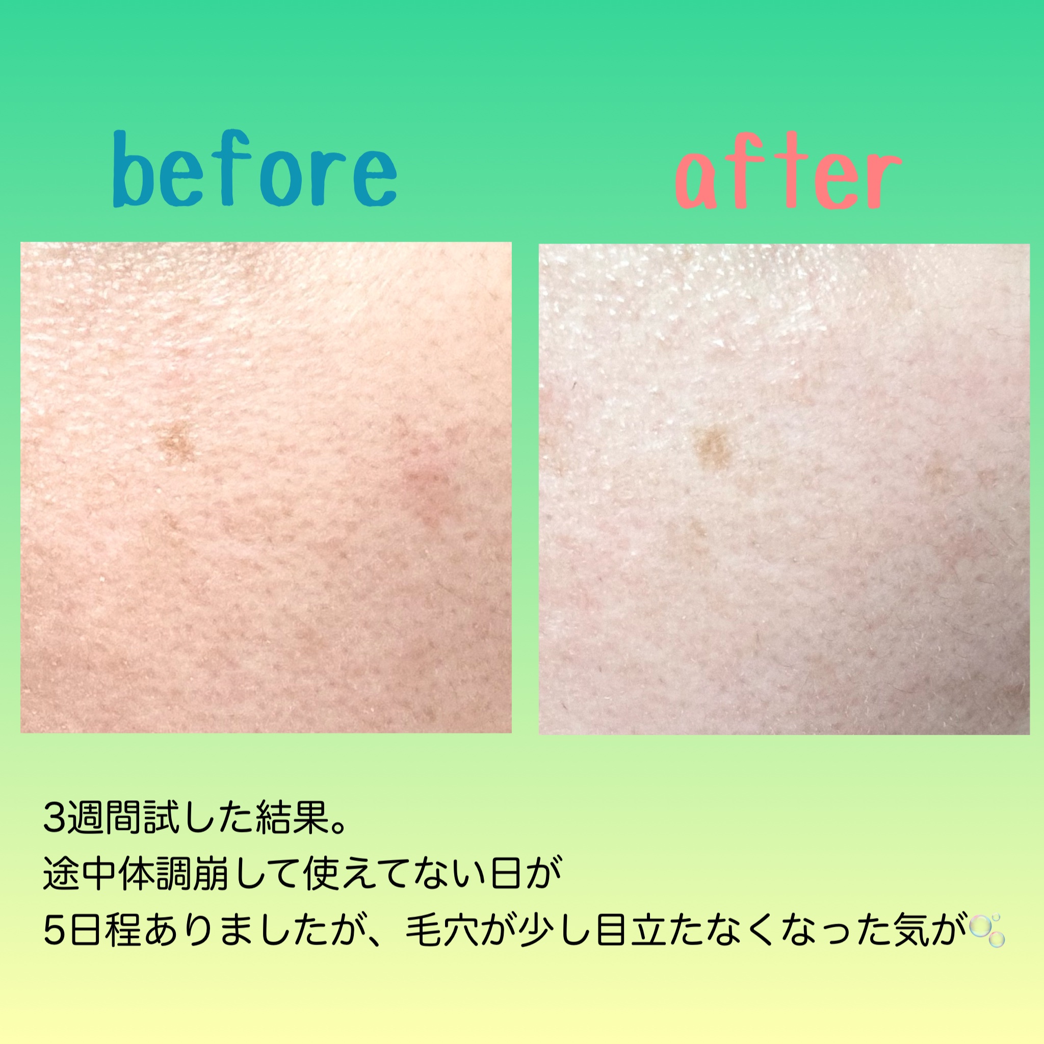 リードルショット300/VT/美容液を使ったクチコミ（2枚目）