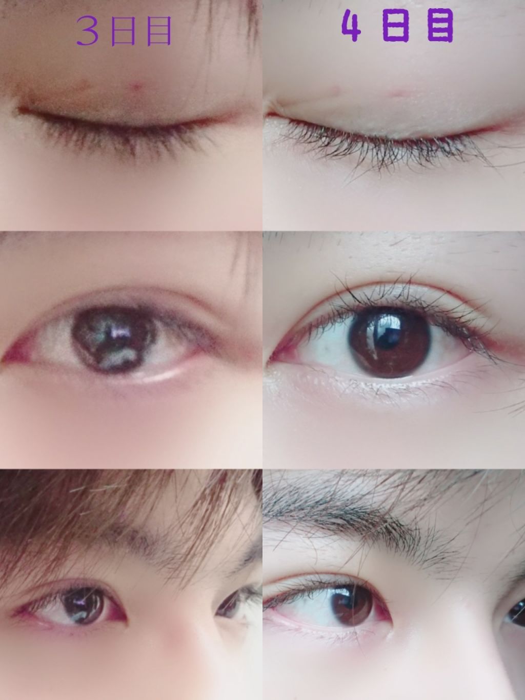 ばさお on LIPS 「4日目です🚩ほぼ安定してきて、今日はコンタクトも付けて生活しま..」(2枚目)