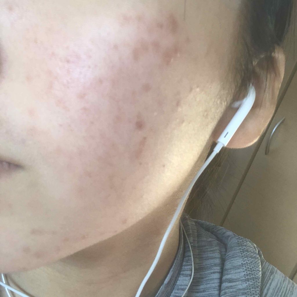 ピロリ菌 on LIPS 「小学5年生からでき始め…中学生になってもなかなか治らないニキビ..」(2枚目)