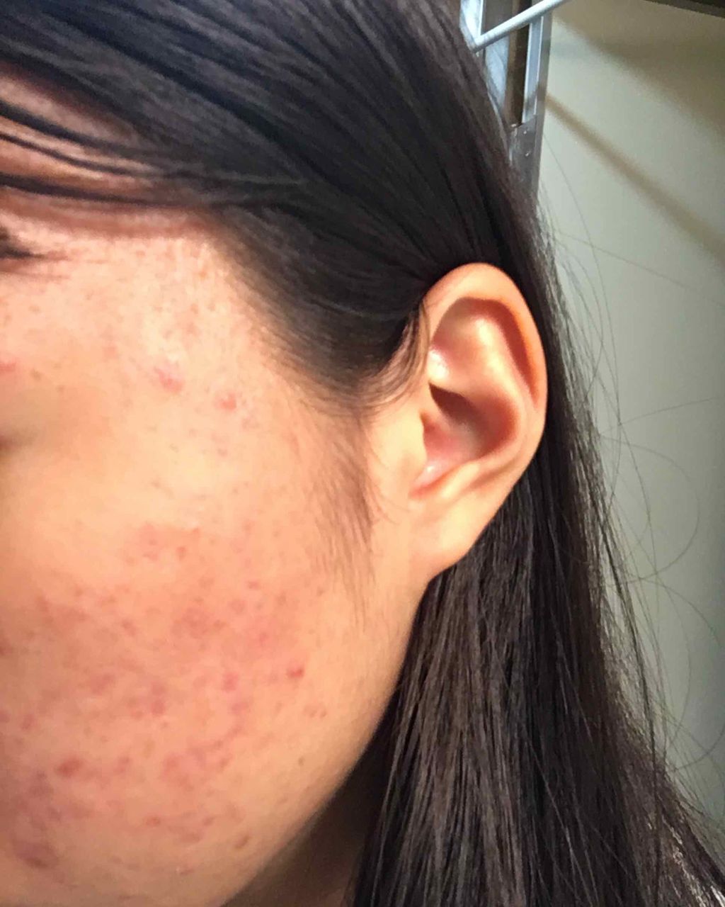 ニキビ治療薬(医薬品)/メンソレータム アクネス/その他を使ったクチコミ（2枚目）