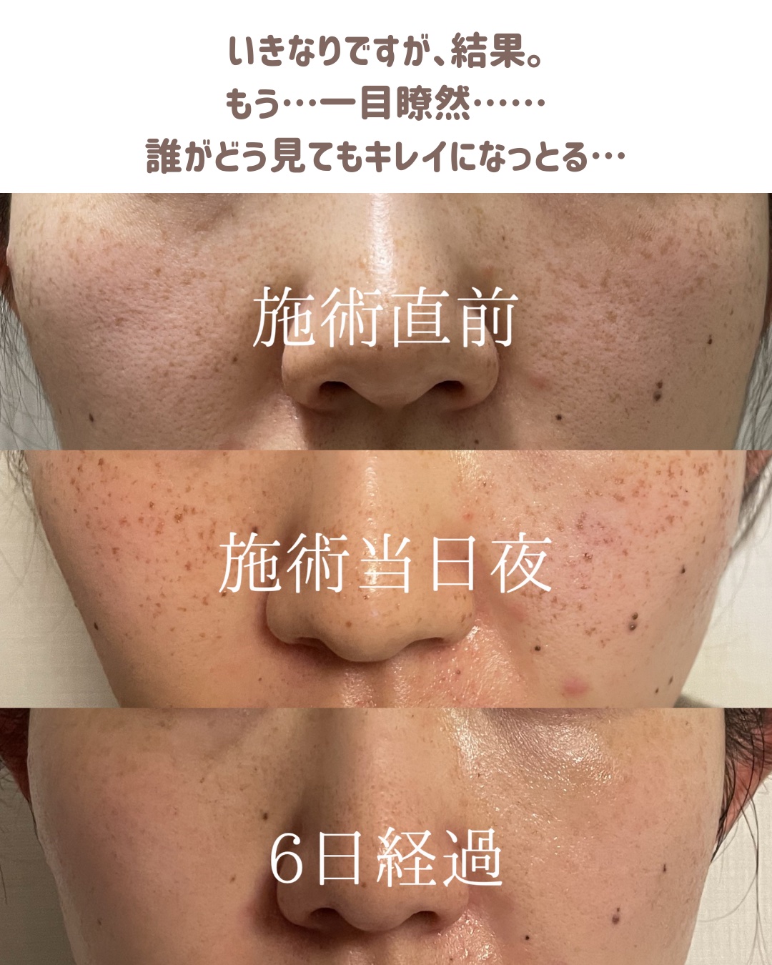 ビオレUV アクアリッチ アクアプロテクトローション(水層パック)/ビオレ/日焼け止めローションを使ったクチコミ（3枚目）