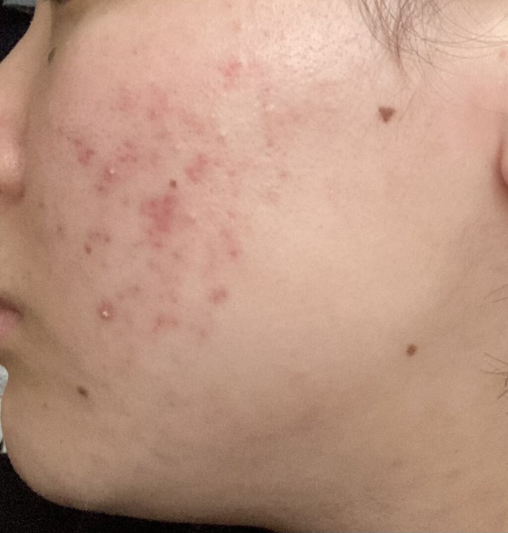 クリンダマイシンゲル(医薬品)/クラシエ薬品/その他を使ったクチコミ（2枚目）