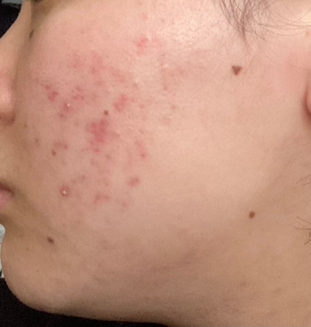 とろり on LIPS 「本格的なニキビ生活から本格的なニキビ跡生活にシフトしました。い..」(2枚目)