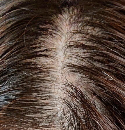 スカルプローション/Rintor/頭皮ローションを使ったクチコミ(2枚目)