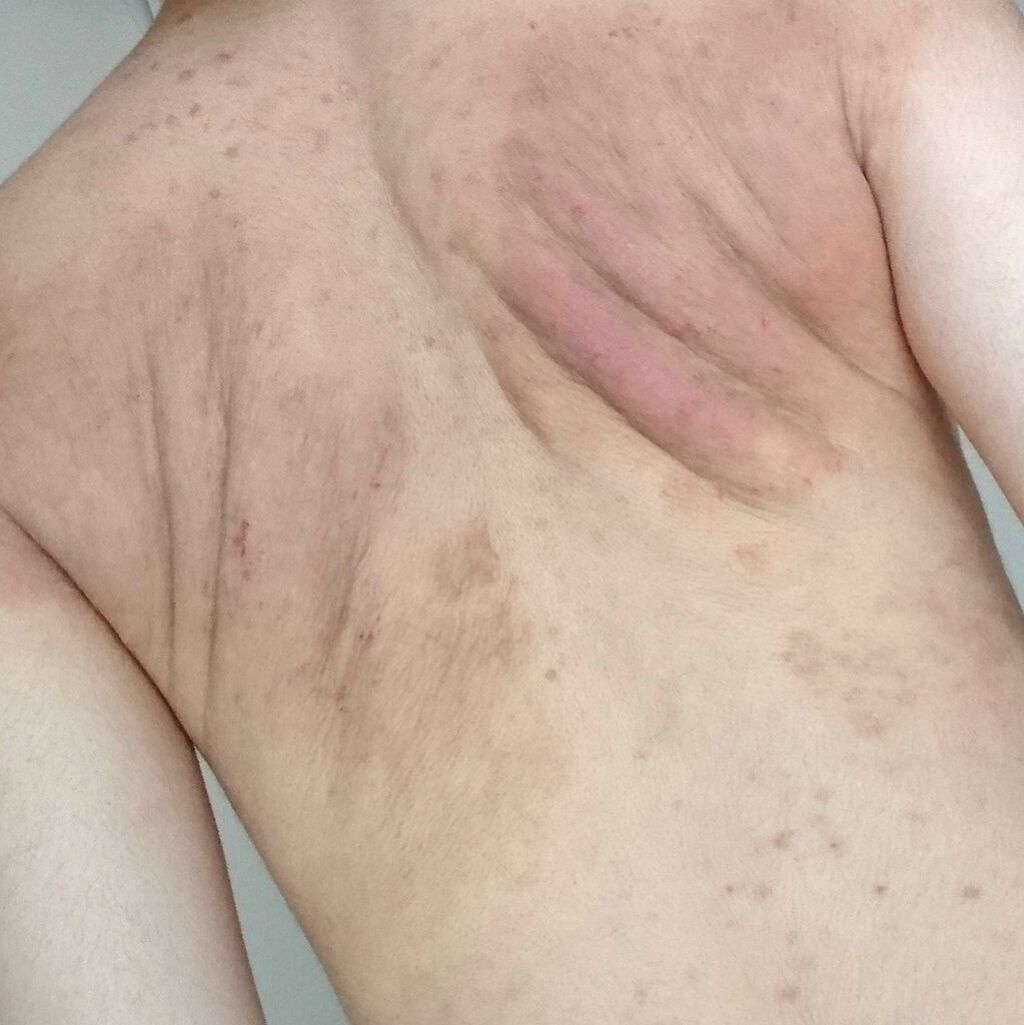 メンソレータムADクリームm(医薬品)/メンソレータムAD/その他を使ったクチコミ(2枚目)