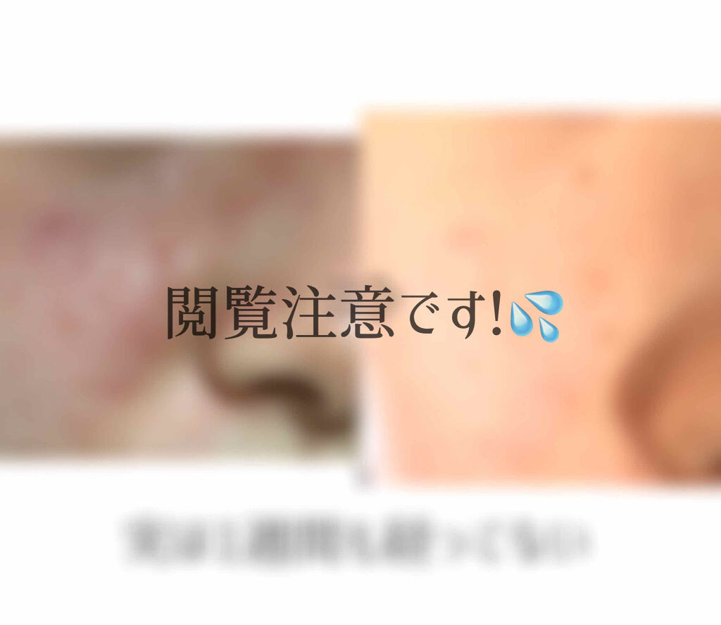 ドルマイコーチ軟膏(医薬品)/ゼリア新薬工業/その他を使ったクチコミ（2枚目）