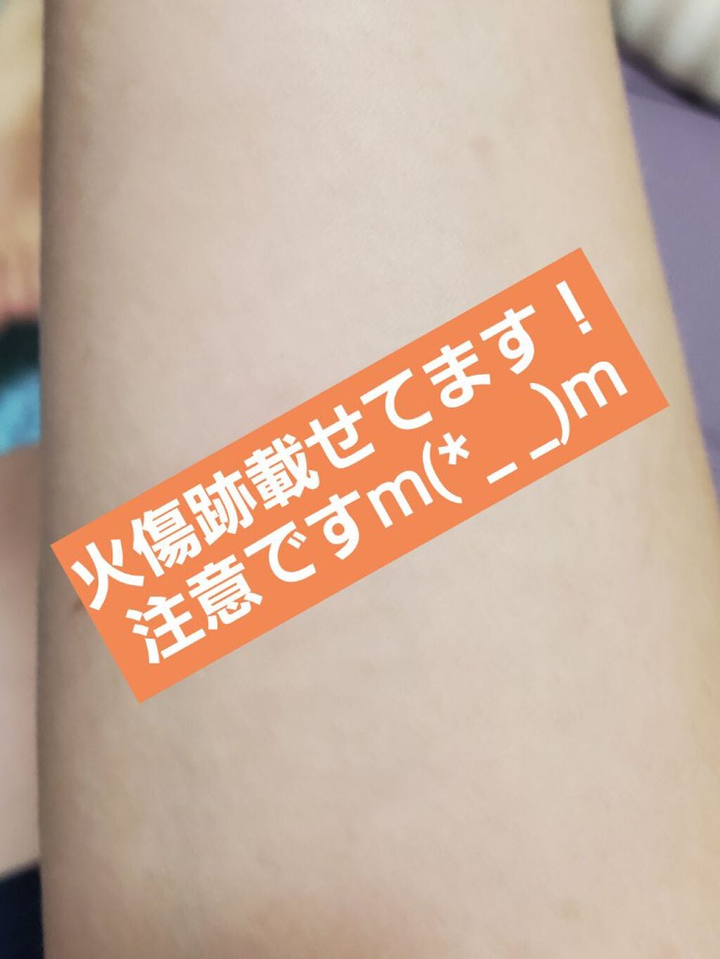 アットノンEX クリーム(医薬品)/アットノン/その他を使ったクチコミ(1枚目)