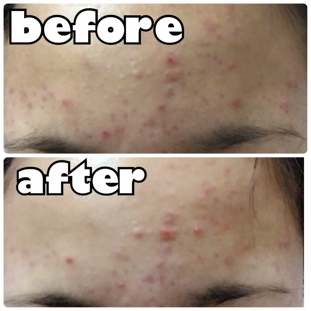 薬用 しみ 集中対策 美容液/メラノCC/美容液を使ったクチコミ（2枚目）