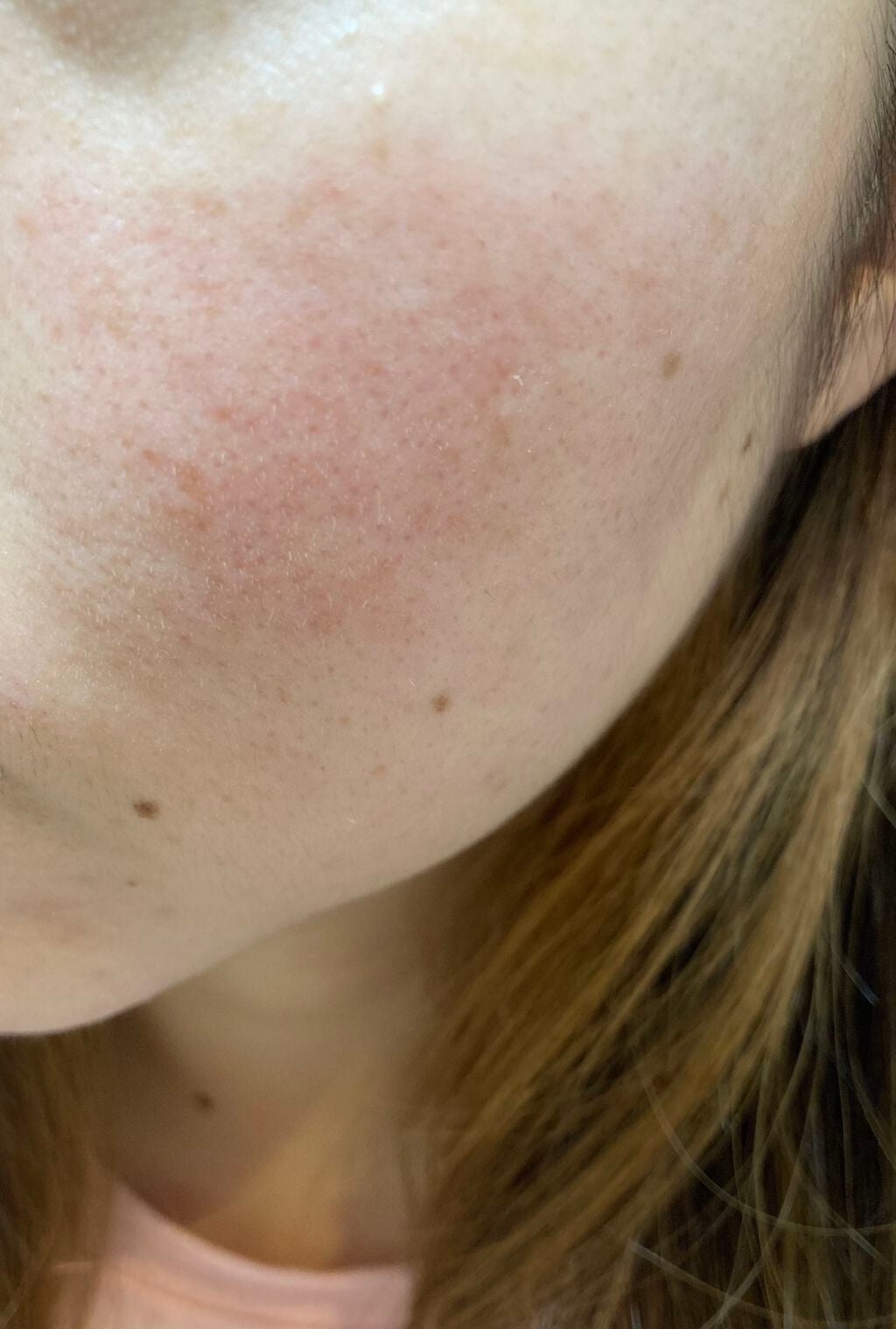 しい on LIPS 「カソーダ22日目順調に皮むけ中!特に鼻がポロポロ!〜カソーダを..」(3枚目)