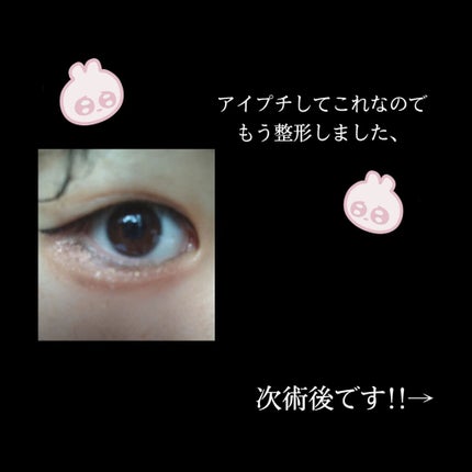 二重整形/その他を使ったクチコミ(1枚目)