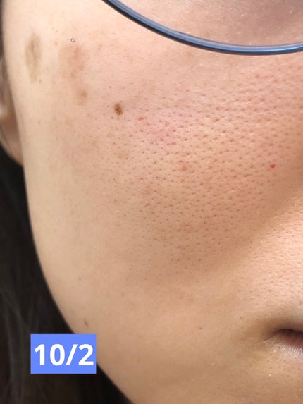 スキンライトセラピーII/Makeon/美顔器・マッサージを使ったクチコミ(5枚目)