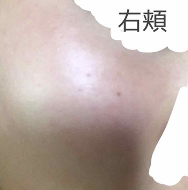 うすしおぽてち on LIPS 「お久しぶりです…ニキビ撲滅日記です…今8ヶ月目ですがこの写真は..」（3枚目）