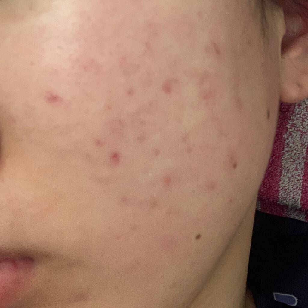 space on LIPS 「ほんまに薄くなってきたなあ!と感じるこの頃!新しいニキビも出に..」(2枚目)