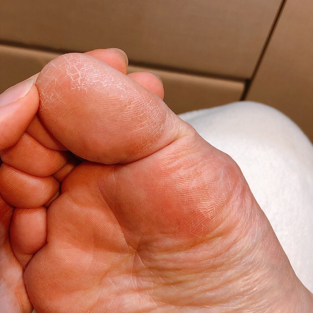 イージーパックDP60分タイプ/ベビーフット/レッグ・フットケアを使ったクチコミ(5枚目)