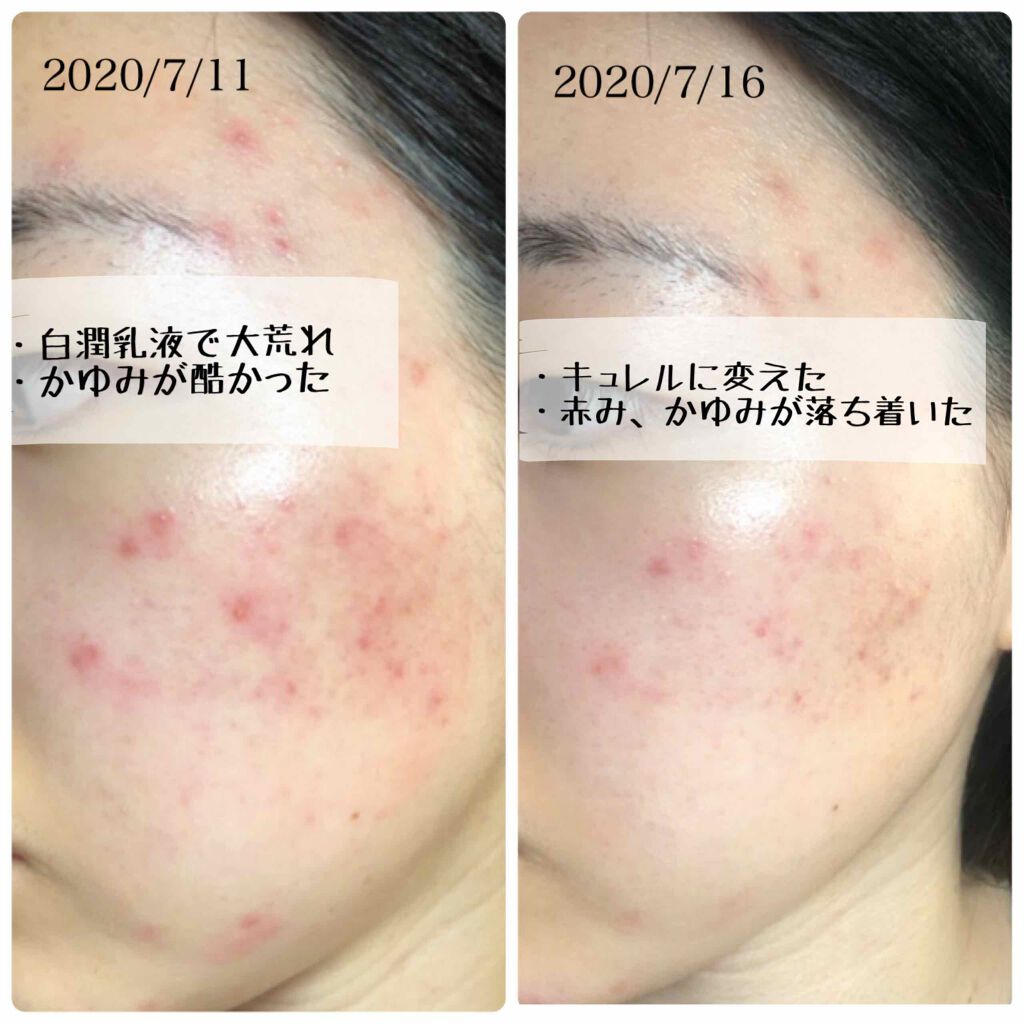 知恵 健康 バッテリー 赤み 肌 化粧 水 Yumekiko Jp