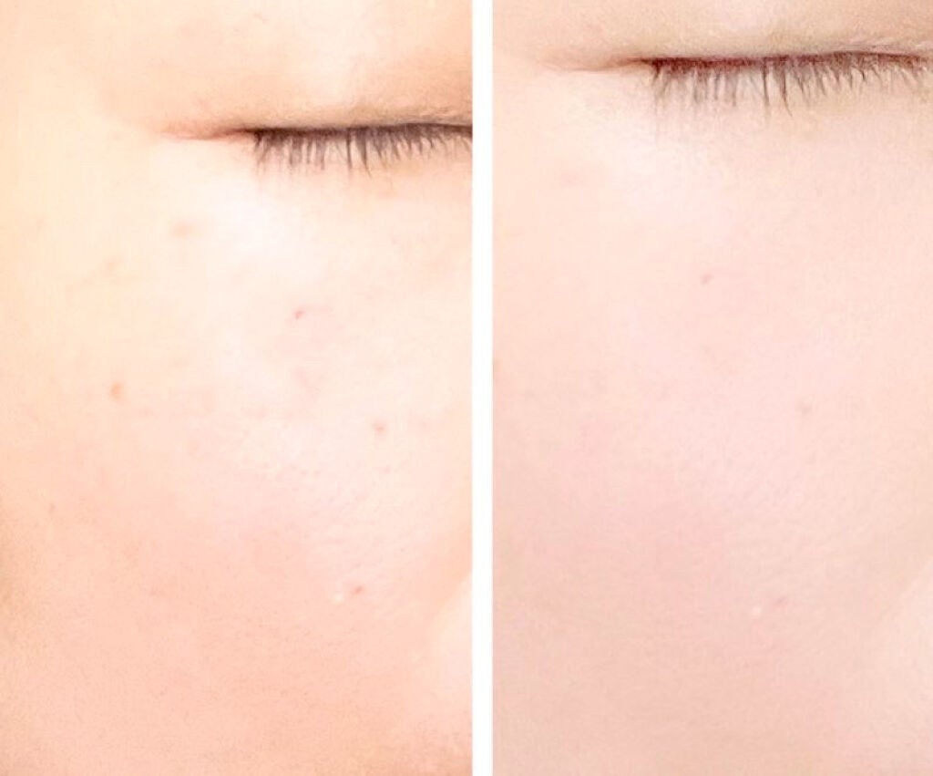 セラム美容液/REJURAN COSMETICS/美容液を使ったクチコミ(5枚目)