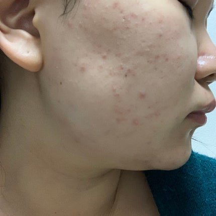 ティーツリーケア ソリューション エッセンシャルマスクEX/MEDIHEAL/シートマスク・パックを使ったクチコミ(4枚目)