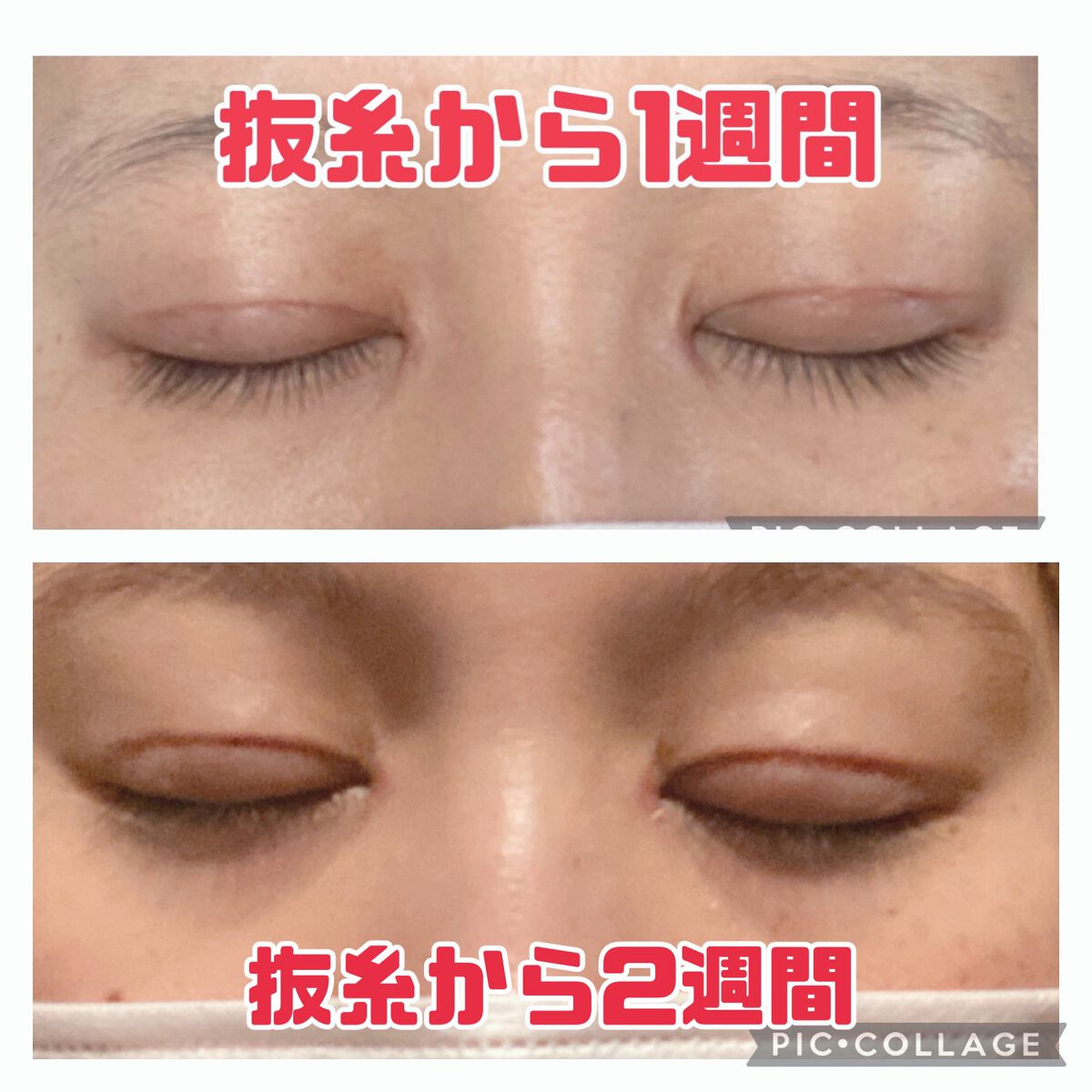 ふうせん @フォロバ100% on LIPS 「3月17日抜糸から2週間今日は、ちょっと腫れてました。その日の..」(2枚目)