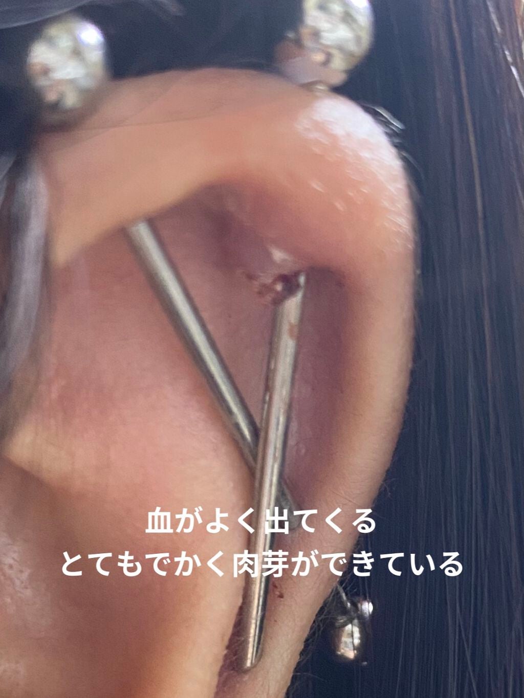 芋子 on LIPS 「みなさんこんばんわ✋インダストリアルの肉芽ができている所を12..」(2枚目)