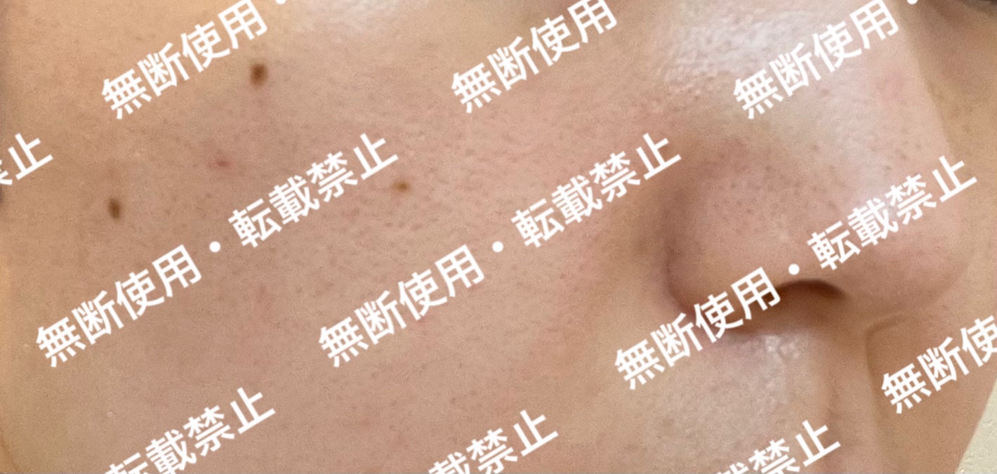 VC ホワイトピールセラム/SKIO/ブースター・導入液を使ったクチコミ(5枚目)