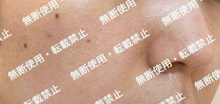 VC ホワイトピールセラム/SKIO/ブースター・導入液を使ったクチコミ(5枚目)