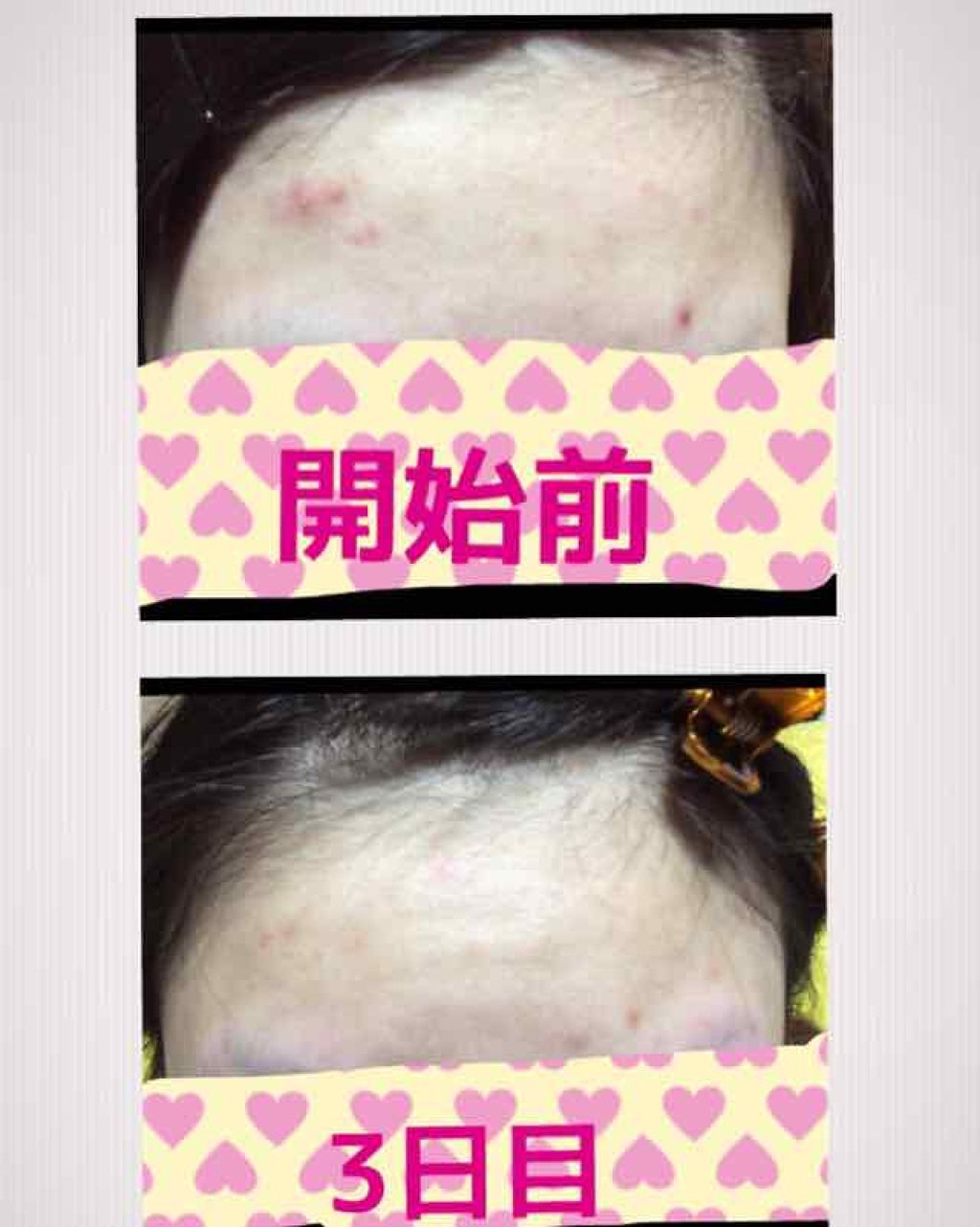 薬用 しみ 集中対策 美容液/メラノCC/美容液を使ったクチコミ(3枚目)