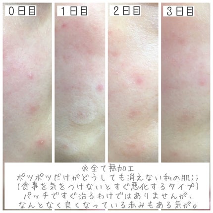 ゼロスポットパッチ/Today’s Cosme/にきびパッチを使ったクチコミ(3枚目)