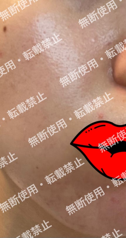 colorful_perfume_r39m on LIPS 「まずこれを初期の肌の状態写真とします。※自分的に肌が1番汚く見..」(4枚目)