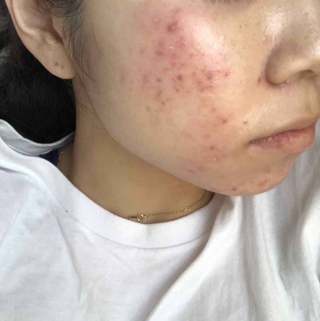 エピデュオゲル/マルホ株式会社/その他を使ったクチコミ（2枚目）