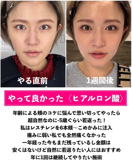 とみりー on LIPS 「36歳がやってよかった美容医療まとめ✨◆───--- - -..」(5枚目)