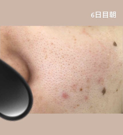 薬用 しみ 集中対策 美容液/メラノCC/美容液を使ったクチコミ(3枚目)