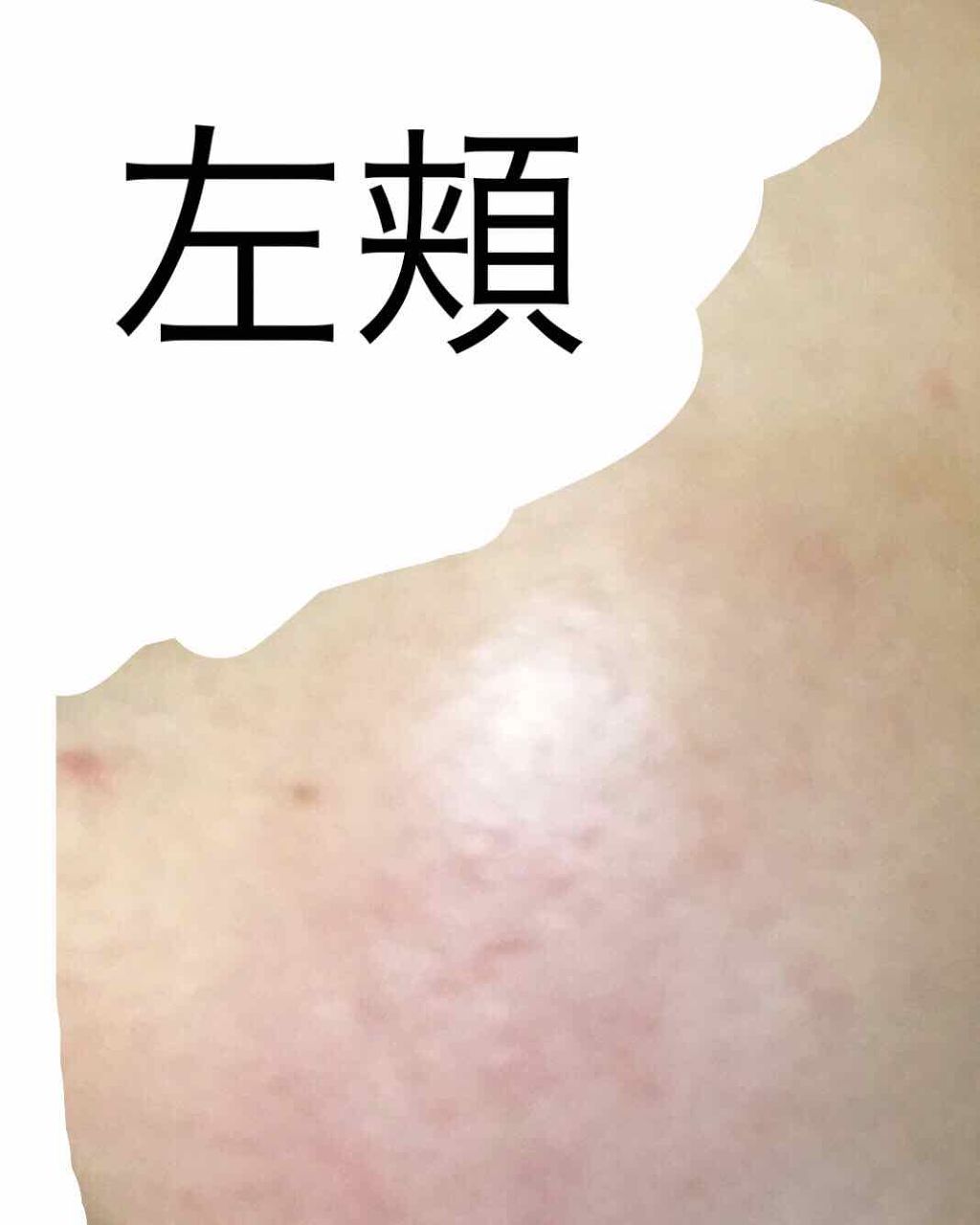 うすしおぽてち on LIPS 「〜ニキビ撲滅日記2週間目〜投稿全然してませんでした…😥😥写真は..」(4枚目)