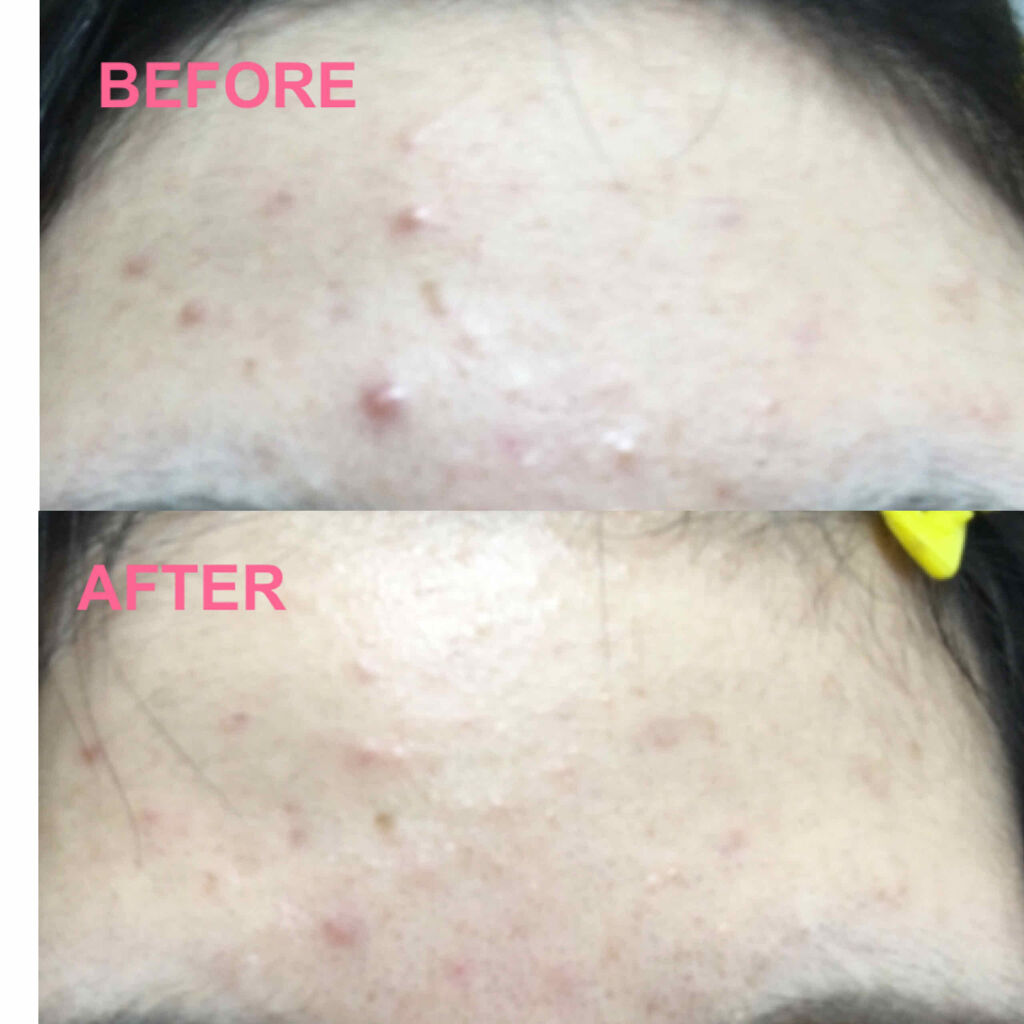 ゼロスポットパッチ/Today’s Cosme/にきびパッチを使ったクチコミ（2枚目）