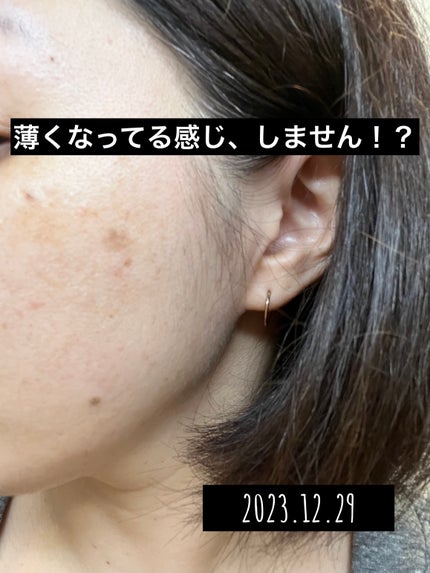 ACローション/パラビオ/化粧水を使ったクチコミ(1枚目)