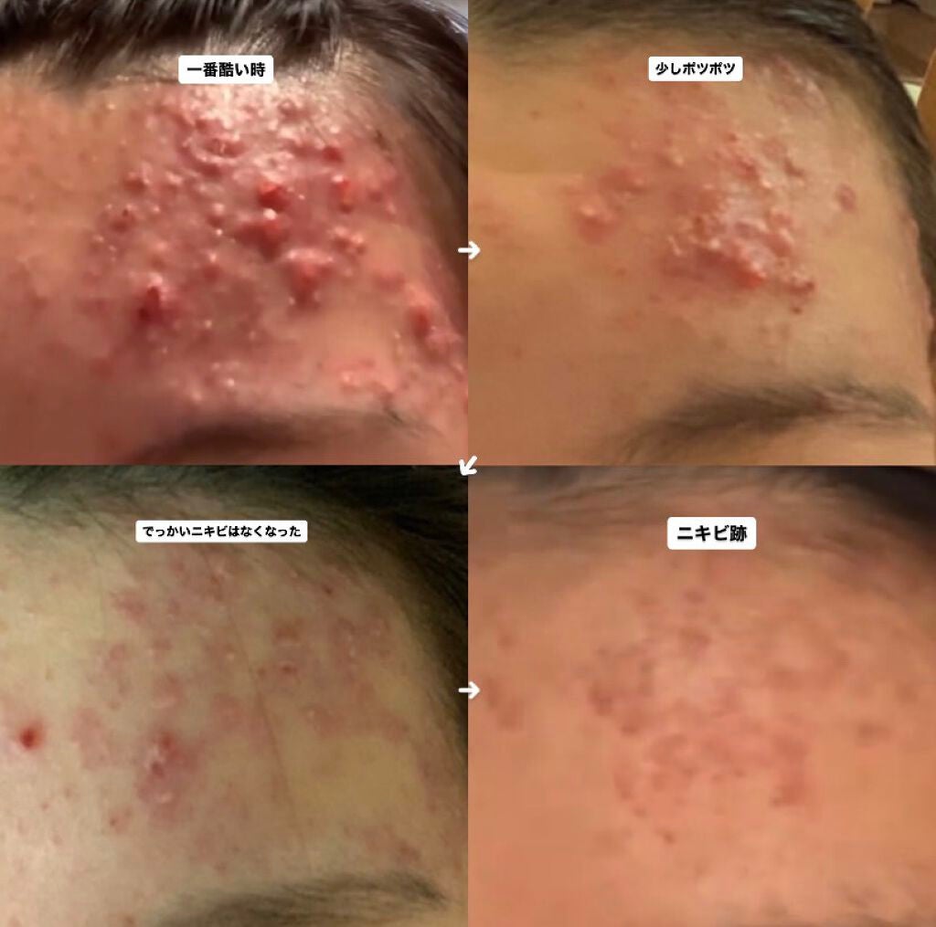 DHC ビタミンCハードカプセル/DHC/美容サプリメントを使ったクチコミ(2枚目)