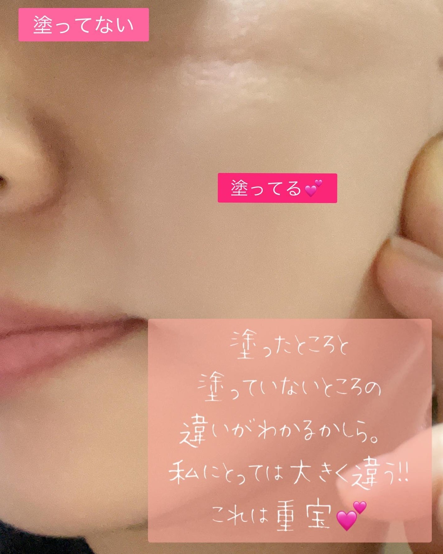 ananamargaret on LIPS 「APLINピンクティーツリーカバーアップグロウクッション21号..」(7枚目)