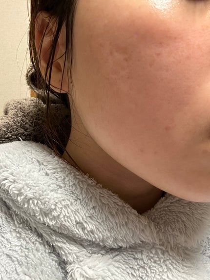 CICA マイルドトナーパッド/VT/トナーパッドを使ったクチコミ(2枚目)