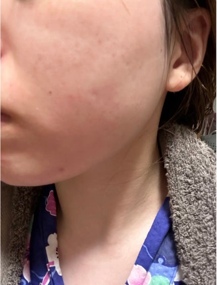 ヴィオテラス Cセラム/ヘルスビューティー/美容液を使ったクチコミ(3枚目)