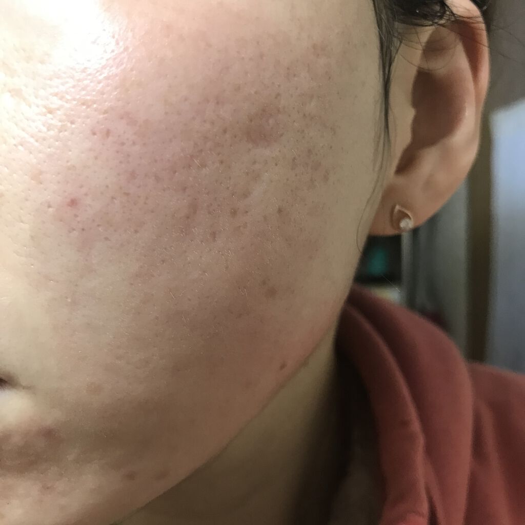 レチノールA 1% アドバンスドリバイタリゼーションクリーム/Life-flo/フェイスクリームを使ったクチコミ（2枚目）