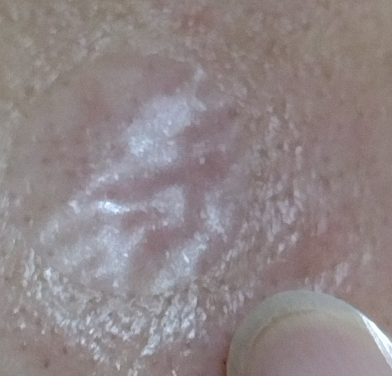 極薄透明パッチ nikipa!/金冠堂/にきびパッチを使ったクチコミ(5枚目)