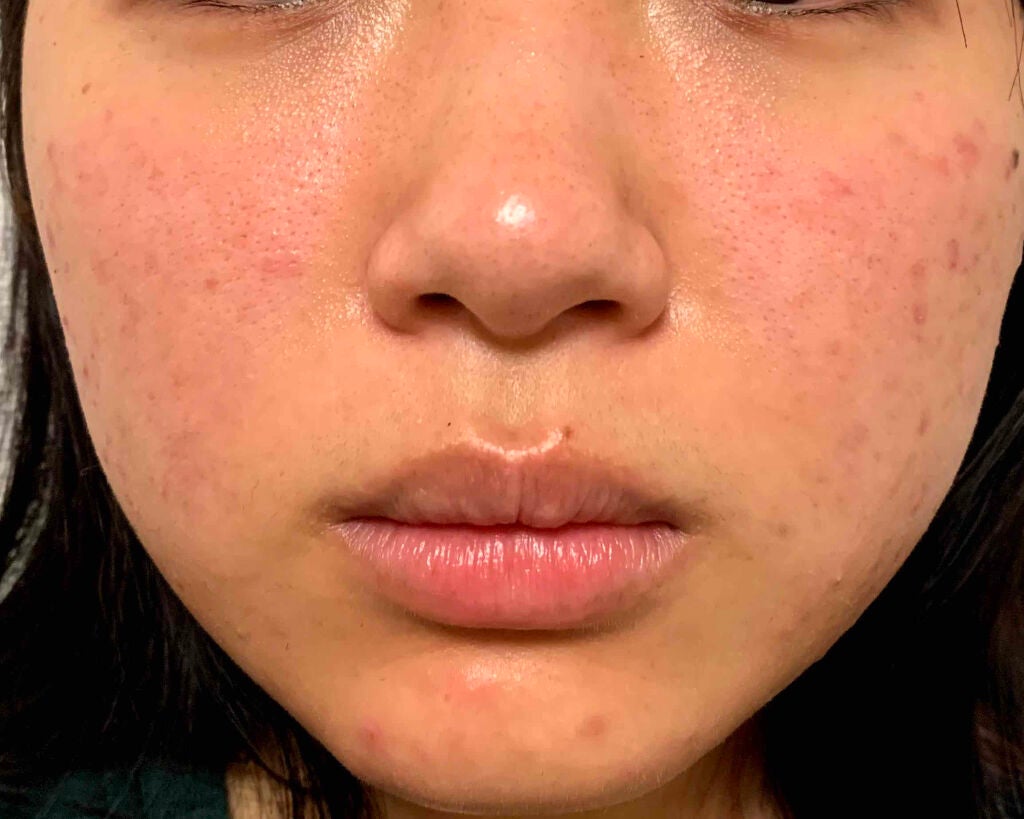 万年ニキビ肌 on LIPS 「5/7前回から3日後〜〜やっぱりじっくり熟成させて出来たニキビ..」(3枚目)