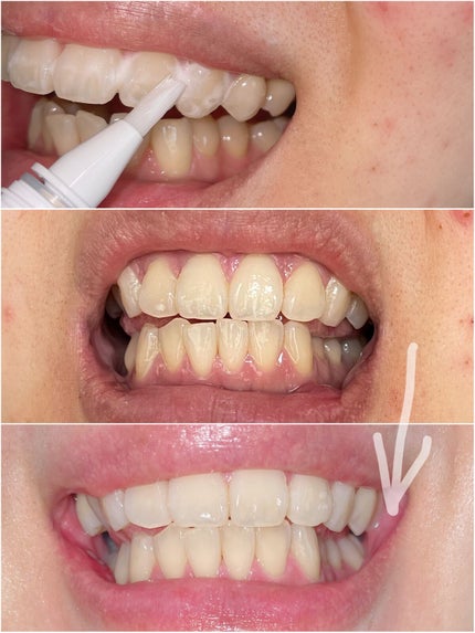 薬用ホワイトニング デンタブラッシュ EX/シーヴァ/その他オーラルケアを使ったクチコミ(5枚目)