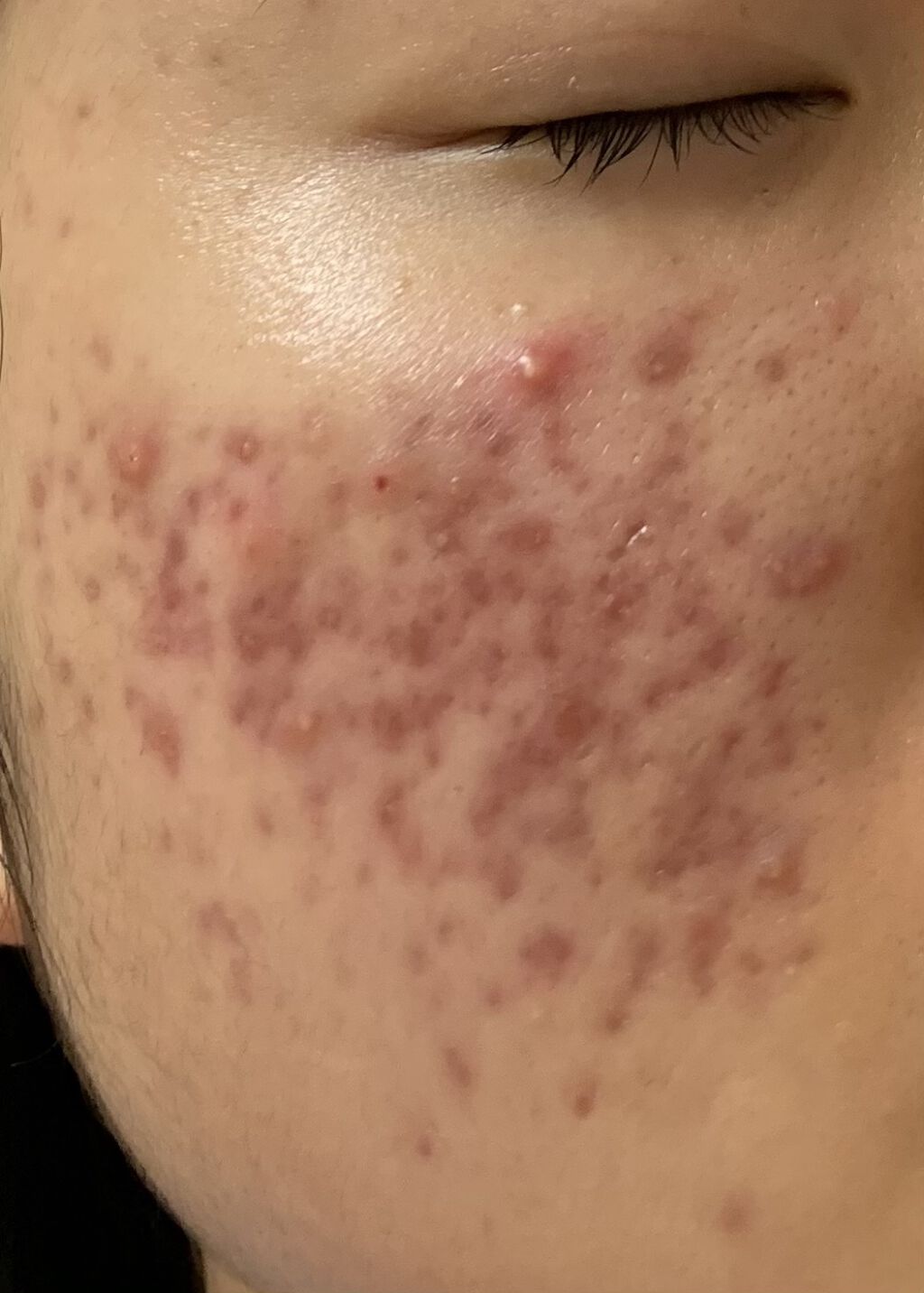 薬用ふわふわな泡洗顔/メンソレータム アクネス/泡洗顔を使ったクチコミ（2枚目）