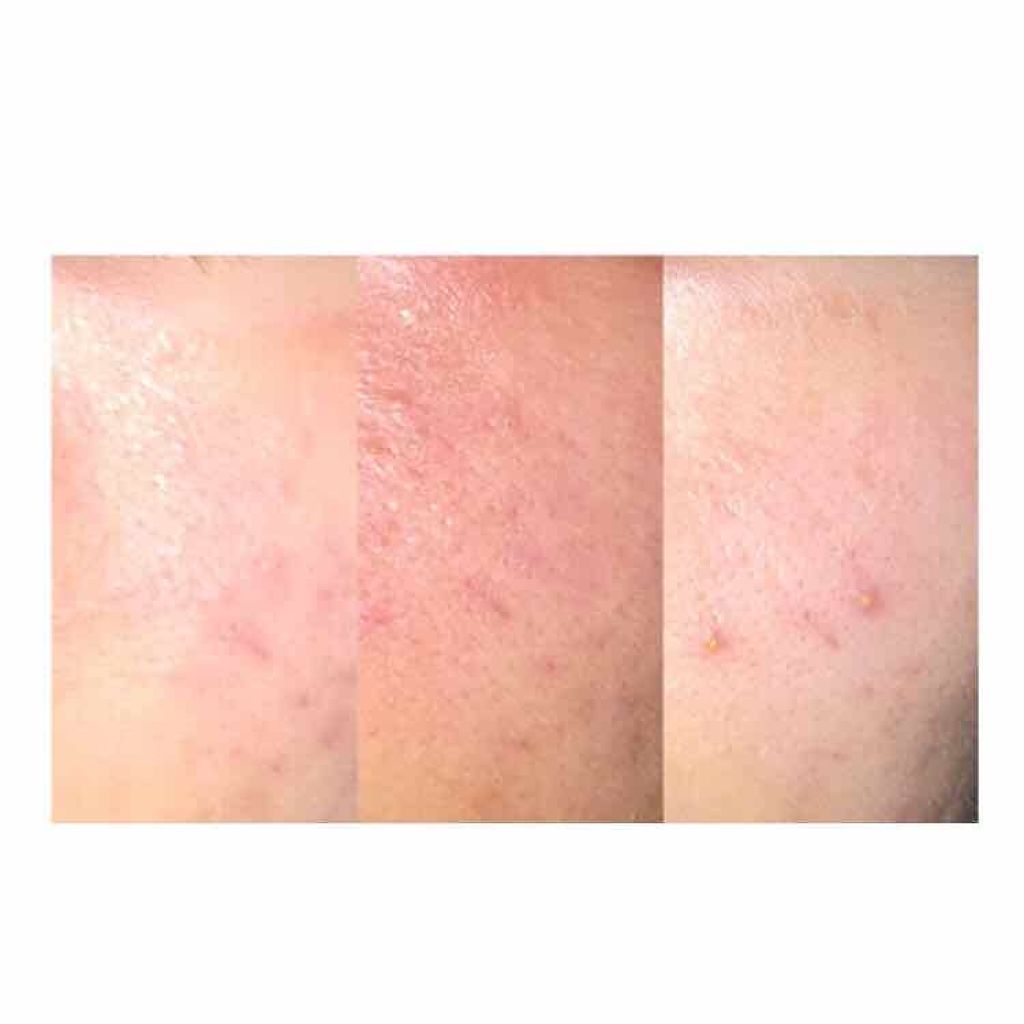 柚月 on LIPS 「※治療中の写真あります。赤みやただれかけている画像もありますの..」(1枚目)