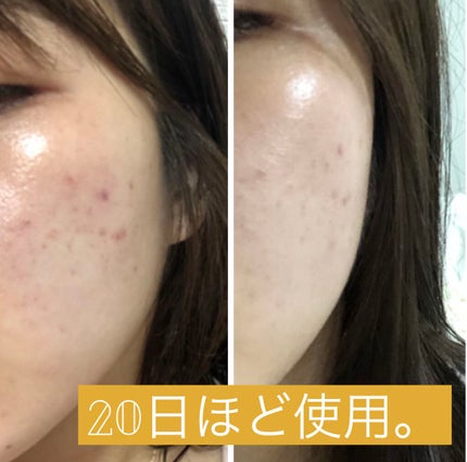 タカミスキンピール/タカミ/ブースター・導入液を使ったクチコミ(2枚目)