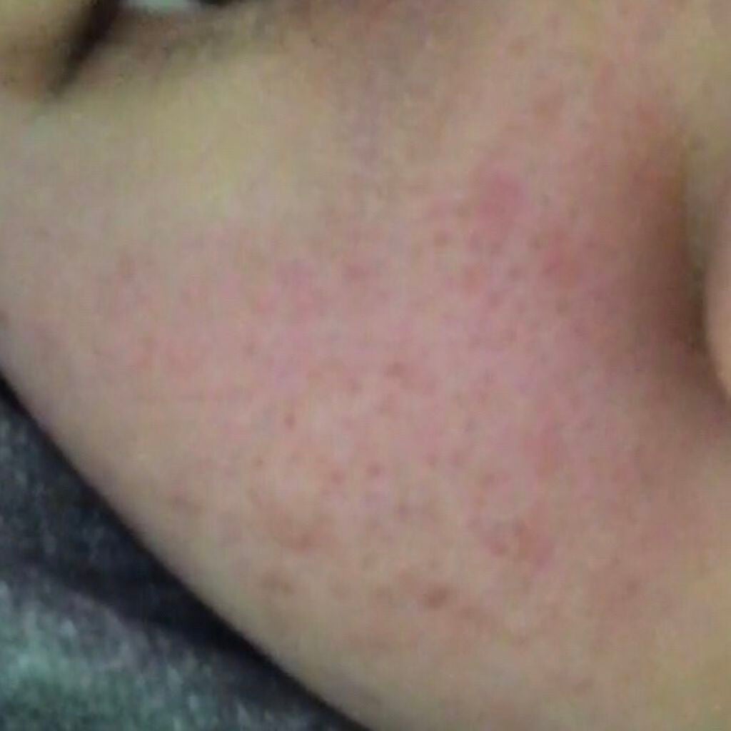 ひな➰ on LIPS 「2日前?くらいから頬がかぶれてて…いつもも顔は赤いんですがいつ..」(3枚目)