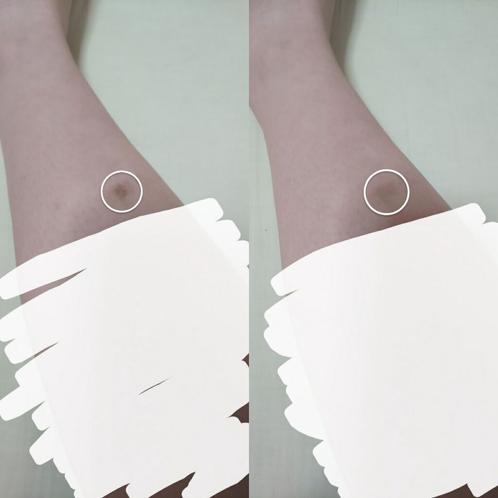 バイオイル/バイオイル/フェイスオイルを使ったクチコミ(1枚目)