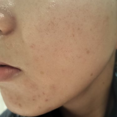 Glucolic Acid 30% Gel Peel/YEOUTH/ピーリングを使ったクチコミ（2枚目）