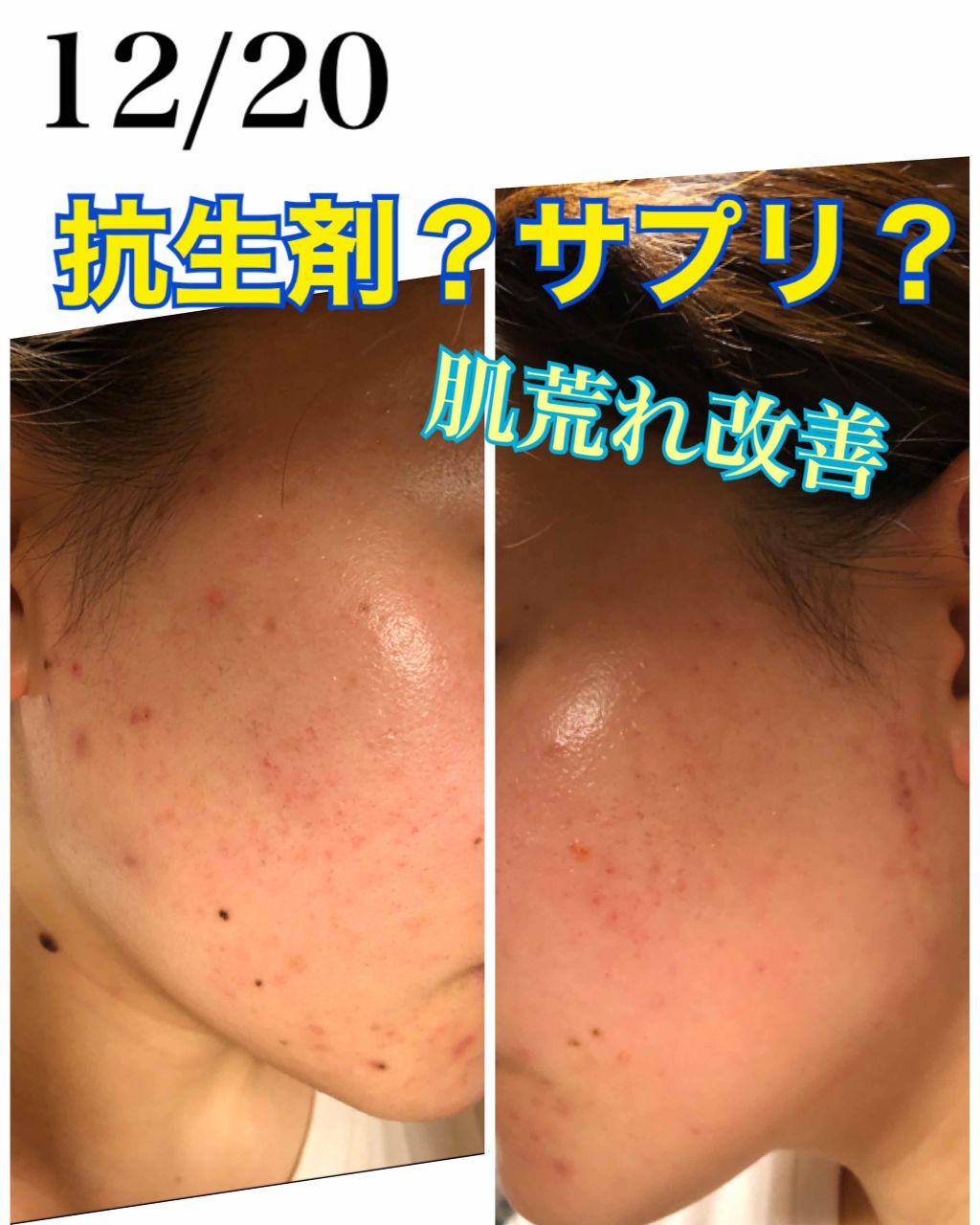 チョコラBBプラス (医薬品)/チョコラBB/その他を使ったクチコミ（1枚目）