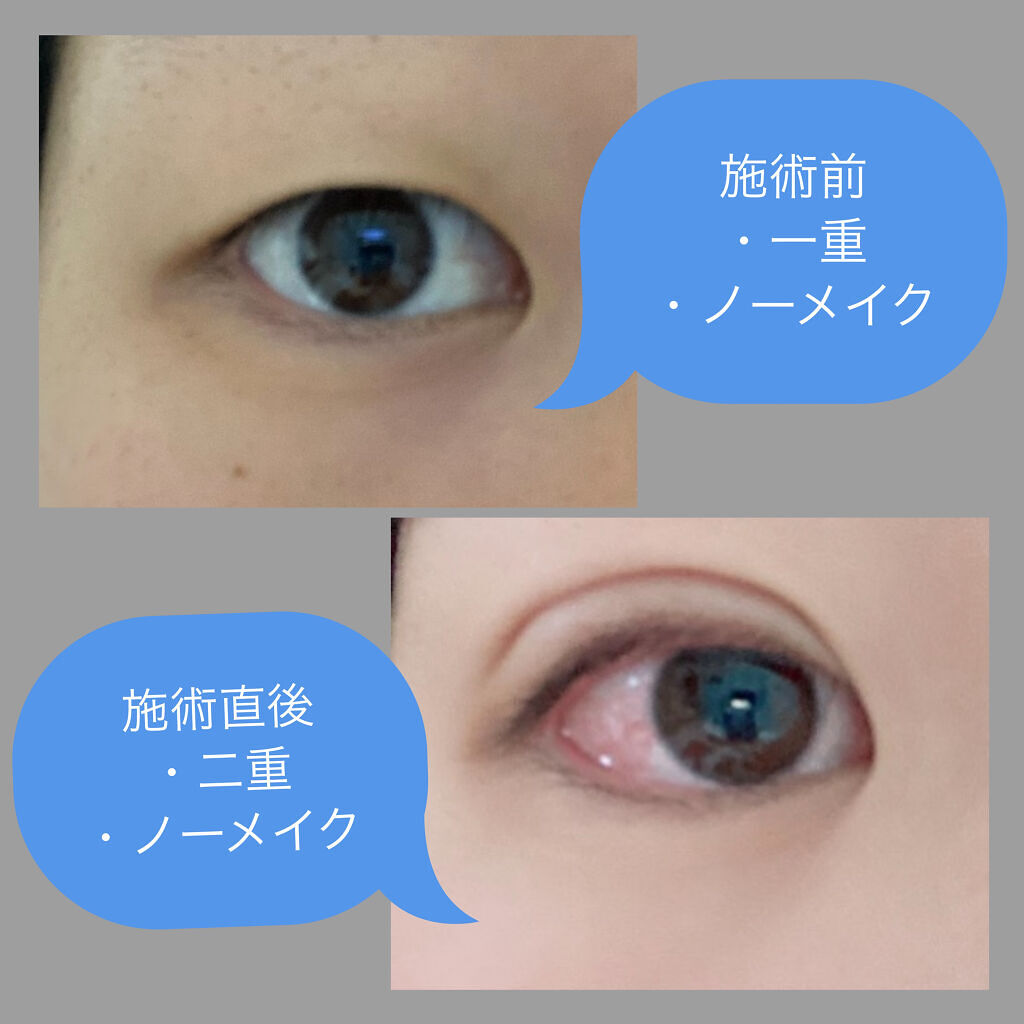 二重整形/その他を使ったクチコミ（2枚目）